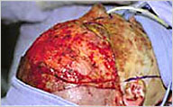 Fascial excision of face day 5 following injury