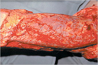 Complete Excision of Non-Viable Tissue