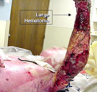 Large Hematoma