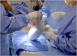 Dressing the INTEGRA<sup>®</sup> Template