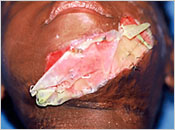 14 days post-op. Silicone separating