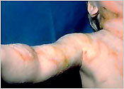Scald injury to the right upper arm, face and chest
