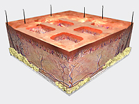 DAY 21+: EPIDERMAL AUTOGRAFT