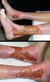 Electrical/flame burn to neck