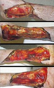 Fascial excision of chest