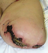 Electrical/flame burn to neck