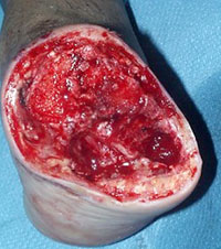 ankle abscess