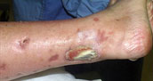 Electrical/flame burn to neck