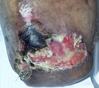 Electrical/flame burn to neck