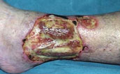 Electrical/flame burn to neck