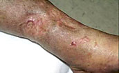 INTEGRA® Dermal Regeneration Template
