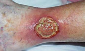Electrical/flame burn to neck