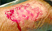 Results of epidermal graft