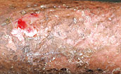 Results of epidermal graft
