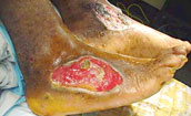Electrical/flame burn to neck