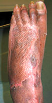 Results of epidermal graft