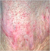 Results of epidermal graft 