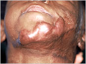 Keloid on Chin