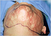 Area of scar contracture release