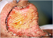 30 days post-op. Neodermis well formed