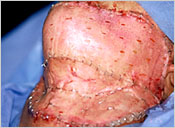 Thin epidermal autograft applied